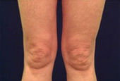 Laser Skin Tightening after 297816