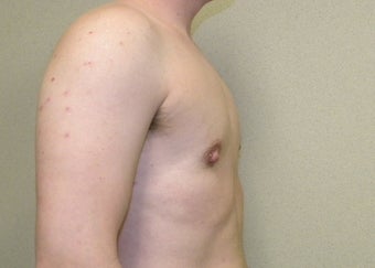Female to Male top Surgery 1190274