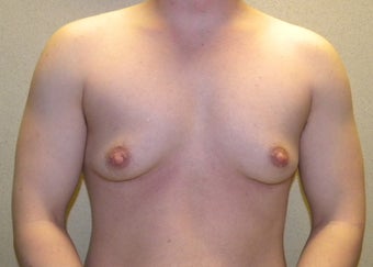 Female to Male top Surgery before 1190274