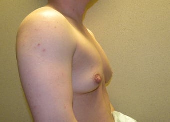 Female to Male top Surgery 1190274