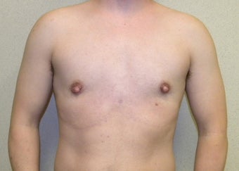 Female to Male top Surgery after 1190274