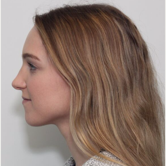 25-34 year old woman treated with Rhinoplasty after 3224692