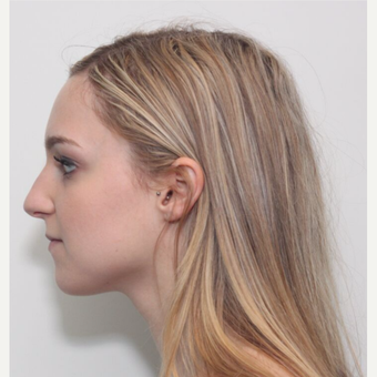 25-34 year old woman treated with Rhinoplasty before 3224692