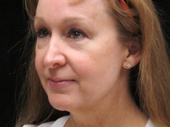 55-64 year old woman treated with Facelift 3508761