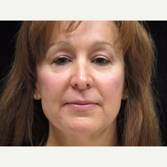 55-64 year old woman treated with Facelift before 3508761