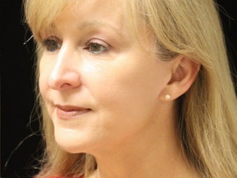 55-64 year old woman treated with Facelift 3508761
