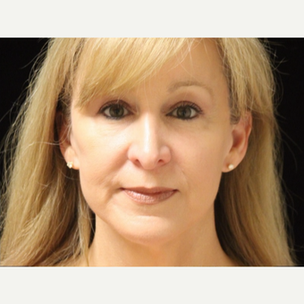 55-64 year old woman treated with Facelift after 3508761
