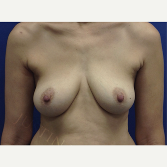 Breast Fat Transfer before 2791123