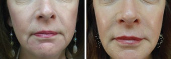 61 Year Old Female with facial fillers, skin care, and Botox before 916684