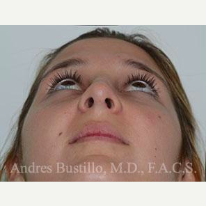 23 year old woman treated with Rhinoplasty before 3460886