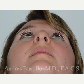 23 year old woman treated with Rhinoplasty after 3460886
