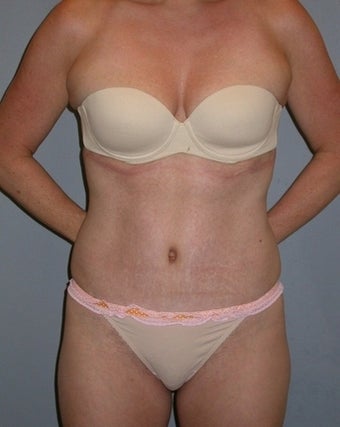 42 year old Tummy Tuck patient after 1325340