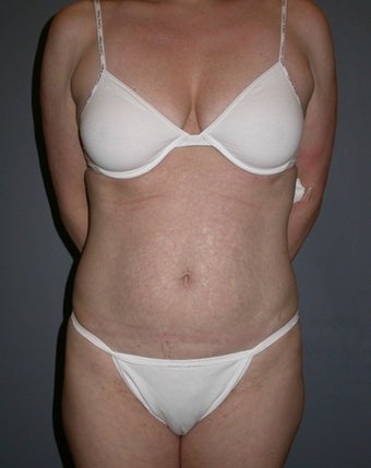42 year old Tummy Tuck patient before 1325340
