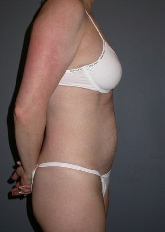 42 year old Tummy Tuck patient 1325340