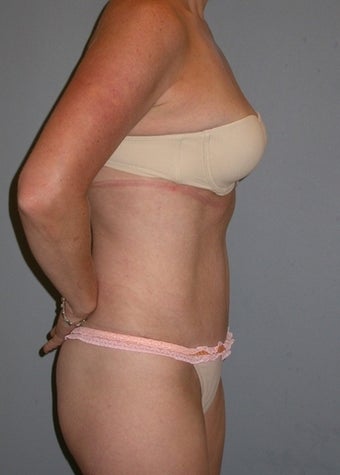 42 year old Tummy Tuck patient 1325340