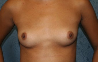 Breast Aug, saline under the muscle before 622088