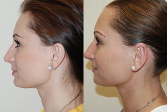 Otoplasty Surgery before 1075799