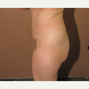 55-64 year old woman treated with Brazilian Butt Lift before 3640291