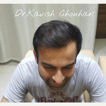 35-44 year treated with Bio Stimulated FUE Hair Transplant after 2836779