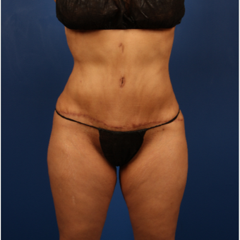 35-44 year old woman treated with Tummy Tuck after 3596502