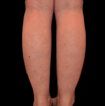 18-24 year old woman treated with Tumescent Liposuction before 2025435