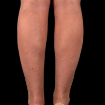 18-24 year old woman treated with Tumescent Liposuction after 2025435