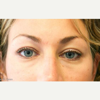 25-34 year old woman treated with Eyelid Surgery before 3093906