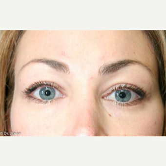 25-34 year old woman treated with Eyelid Surgery after 3093906