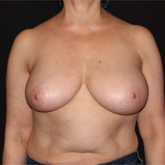 55-64 year old woman with Scarless Breast Reduction before 3538473