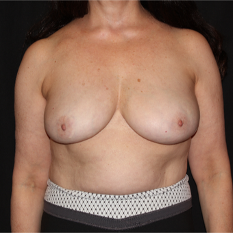 55-64 year old woman with Scarless Breast Reduction after 3538473