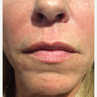 45-54 year old woman treated with Belotero after 3458998