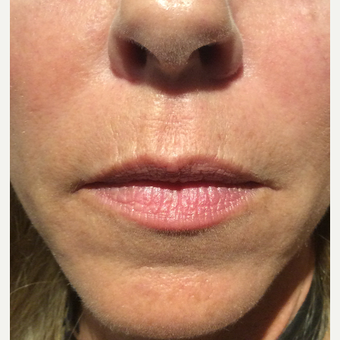 45-54 year old woman treated with Belotero before 3458998