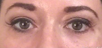 25-34 year old woman treated with Voluma after 2103351