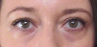25-34 year old woman treated with Voluma before 2103351