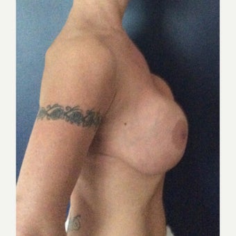 35-44 year old woman treated with 'en bloc' Breast Implant Removal and full uplift before 2465478