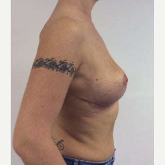 35-44 year old woman treated with 'en bloc' Breast Implant Removal and full uplift after 2465478