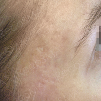 24 year old female with post-acne scars treated with RecoSMA after 2974628