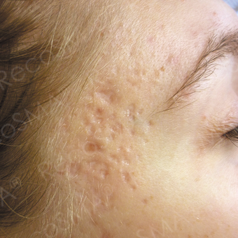 24 year old female with post-acne scars treated with RecoSMA before 2974628