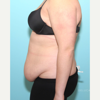 Abdominoplasty With Liposuction of the Abdomen, Flanks, and Upper Back before 3446909