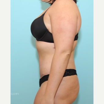 Abdominoplasty With Liposuction of the Abdomen, Flanks, and Upper Back after 3446909