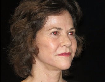 55-64 year old woman treated with Facelift, quad blepharoplasty, filler after 2509115