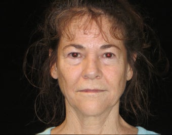 55-64 year old woman treated with Facelift, quad blepharoplasty, filler 2509115