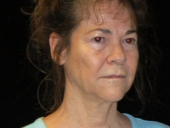 55-64 year old woman treated with Facelift, quad blepharoplasty, filler before 2509115
