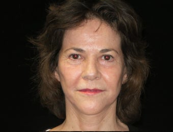 55-64 year old woman treated with Facelift, quad blepharoplasty, filler 2509115