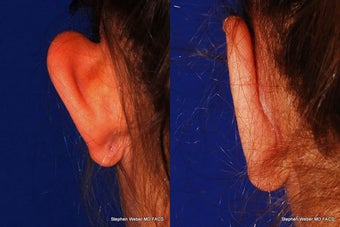 Ear Surgery before 1445761