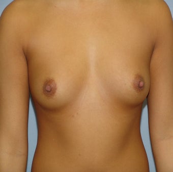Breast Augmentation, Breast Implants before 1155782