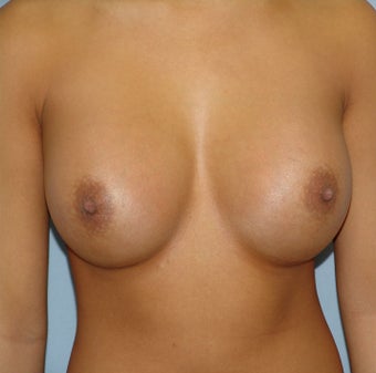 Breast Augmentation, Breast Implants after 1155782