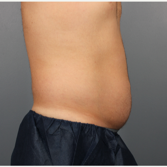 44 year old man treated with CoolSculpting to the Abdomen and Flanks before 3507490