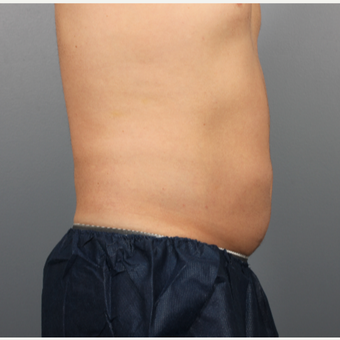 44 year old man treated with CoolSculpting to the Abdomen and Flanks after 3507490
