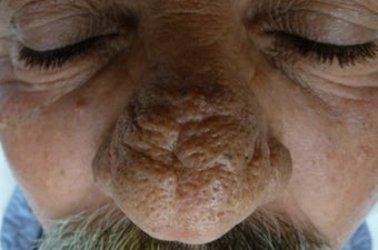 61 year old male with rhinophyma before 1433497
